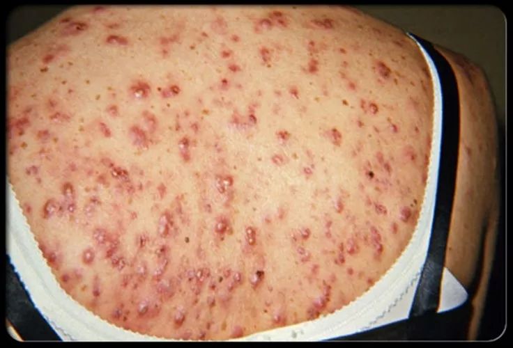 痘里面有小米粒(痘痘里面的小米粒要挤出来吗)